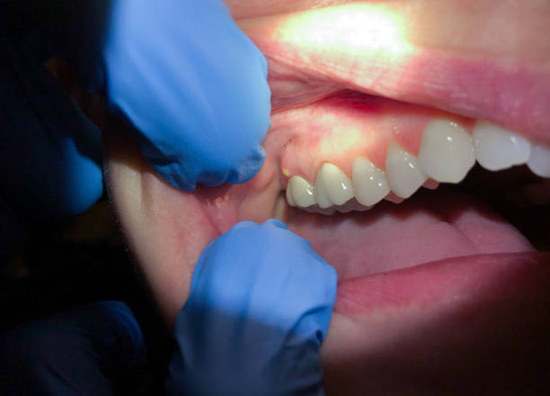 Best Broken or Cracked Tooth Emergency Dentist in Amityville, NY